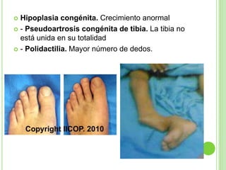  Hipoplasia congénita. Crecimiento anormal
 - Pseudoartrosis congénita de tibia. La tibia no
está unida en su totalidad
 - Polidactilia. Mayor número de dedos.
 