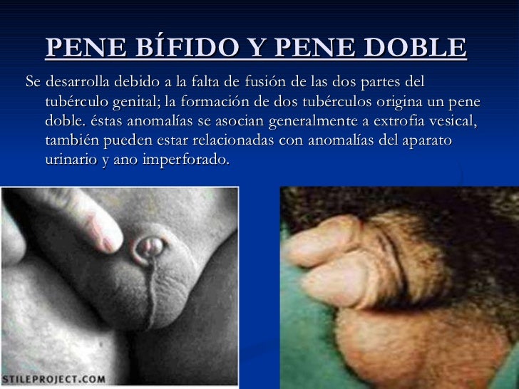 El tratamiento del miembro aumentado