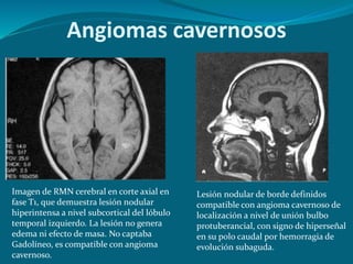 Imagen de RMN cerebral en corte axial en
fase T1, que demuestra lesión nodular
hiperintensa a nivel subcortical del lóbulo
temporal izquierdo. La lesión no genera
edema ni efecto de masa. No captaba
Gadolíneo, es compatible con angioma
cavernoso.
Lesión nodular de borde definidos
compatible con angioma cavernoso de
localización a nivel de unión bulbo
protuberancial, con signo de hiperseñal
en su polo caudal por hemorragia de
evolución subaguda.
Angiomas cavernosos
 