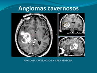 Angiomas cavernosos
ANGIOMA CAVERNOSO EN AREA MOTORA
 