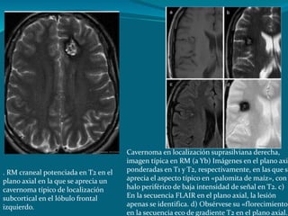. RM craneal potenciada en T2 en el
plano axial en la que se aprecia un
cavernoma típico de localización
subcortical en el lóbulo frontal
izquierdo.
Cavernoma en localización suprasilviana derecha,
imagen típica en RM (a Yb) Imágenes en el plano axia
ponderadas en T1 y T2, respectivamente, en las que se
aprecia el aspecto típico en «palomita de maíz», con
halo periférico de baja intensidad de señal en T2. c)
En la secuencia FLAIR en el plano axial, la lesión
apenas se identifica. d) Obsérvese su «florecimiento»
en la secuencia eco de gradiente T2 en el plano axial.
 