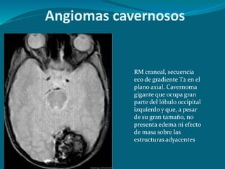RM craneal, secuencia
eco de gradiente T2 en el
plano axial. Cavernoma
gigante que ocupa gran
parte del lóbulo occipital
izquierdo y que, a pesar
de su gran tamaño, no
presenta edema ni efecto
de masa sobre las
estructuras adyacentes
Angiomas cavernosos
 