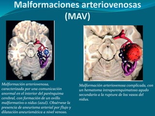 Malformaciones arteriovenosas
(MAV)
Malformación arteriovenosa,
caracterizada por una comunicación
anormal en el interior del parénquima
cerebral, con formación de un ovillo
malformativo o nidus (azul). Obsérvese la
presencia de aneurisma arterial por flujo y
dilatación aneurismática a nivel venoso.
Malformación arteriovenosa complicada, con
un hematoma intraparenquimatoso agudo
secundario a la ruptura de los vasos del
nidus.
 