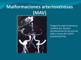 Malformaciones arteriovenosas
(MAV)
Imagen de angiorresonancia
cerebral que muestra
simultáneamente las arterias
nido y venoso de la MAV
parietal derecha.
 