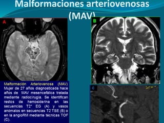 Malformaciones arteriovenosas
(MAV)
 