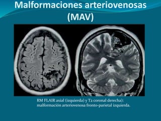 Malformaciones arteriovenosas
(MAV)
RM FLAIR axial (izquierda) y T2 coronal derecha):
malformación arteriovenosa fronto-parietal izquierda.
 