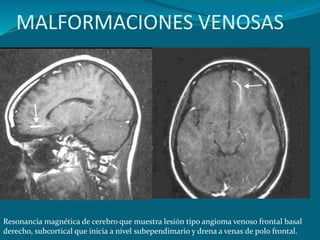 MALFORMACIONES VENOSAS
Resonancia magnética de cerebro que muestra lesión tipo angioma venoso frontal basal
derecho, subcortical que inicia a nivel subependimario y drena a venas de polo frontal.
 
