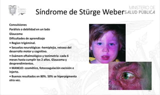 Síndrome de Stürge Weber
Convulsiones
Parálisis o debilidad en un lado
Glaucoma
Dificultades de aprendizaje
• Region trigéminal.
• Secuelas neurológicas -hemiplejia, retraso del
desarrollo motor y cognitivo.
• Exámem oftalmológico y tonimetria -cada 6
meses hasta cumplir los 2 años. Glaucoma y
desprendimientos.
• MANEJO: cosmético, fotocoagulación excisión e
injerto.
• Buenos resultados en 80%. 50% se hiperpigmenta
otra vez.
41
 