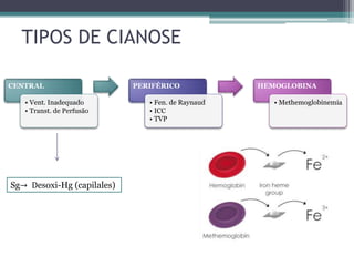 TIPOS DE CIANOSE
CENTRAL
• Vent. Inadequado
• Transt. de Perfusão
PERIFÉRICO
• Fen. de Raynaud
• ICC
• TVP
HEMOGLOBINA
• Methemoglobinemia
Sg→ Desoxi-Hg (capilales)
 