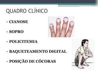 QUADRO CLÍNICO
• CIANOSE
• SOPRO
• POLICITEMIA
• BAQUETEAMENTO DIGITAL
• POSIÇÃO DE CÓCORAS
 
