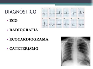 DIAGNÓSTICO
• ECG
• RADIOGRAFIA
• ECOCARDIOGRAMA
• CATETERISMO
 