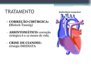 TRATAMENTO
• CORREÇÃO CIRÚRGICA:
(Blalock-Taussig)
- ASSINTOMÁTICO: correção
cirúrgica 6 a 12 meses de vida.
- CRISE DE CIANOSE:
cirurgia IMEDIATA
 