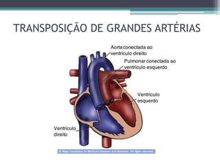 TRANSPOSIÇÃO DE GRANDES ARTÉRIAS
 