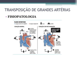 • FISIOPATOLOGIA
TRANSPOSIÇÃO DE GRANDES ARTÉRIAS
 