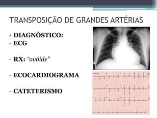 • DIAGNÓSTICO:
- ECG
- RX: “ovóide”
- ECOCARDIOGRAMA
- CATETERISMO
TRANSPOSIÇÃO DE GRANDES ARTÉRIAS
 