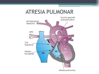 ATRESIA PULMONAR
 