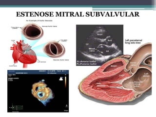 ESTENOSE MITRAL SUBVALVULAR
 