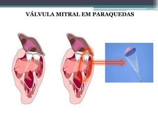 VÁLVULA MITRAL EM PARAQUEDAS
 