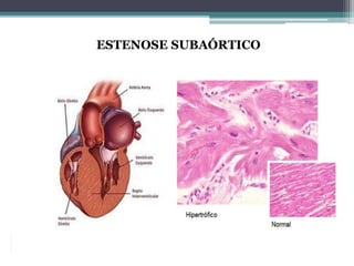 ESTENOSE SUBAÓRTICO
 