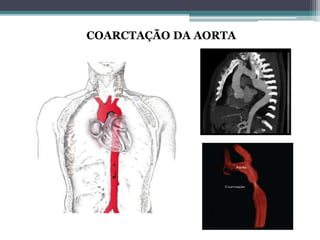 COARCTAÇÃO DA AORTA
 