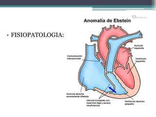 • FISIOPATOLOGIA:
 