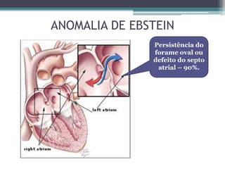 ANOMALIA DE EBSTEIN
Persistência do
forame oval ou
defeito do septo
atrial – 90%.
 