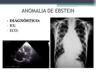 • DIAGNÓSTICO:
- RX:
- ECO:
ANOMALIA DE EBSTEIN
 