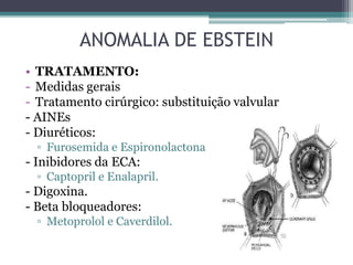 • TRATAMENTO:
- Medidas gerais
- Tratamento cirúrgico: substituição valvular
- AINEs
- Diuréticos:
▫ Furosemida e Espironolactona
- Inibidores da ECA:
▫ Captopril e Enalapril.
- Digoxina.
- Beta bloqueadores:
▫ Metoprolol e Caverdilol.
ANOMALIA DE EBSTEIN
 