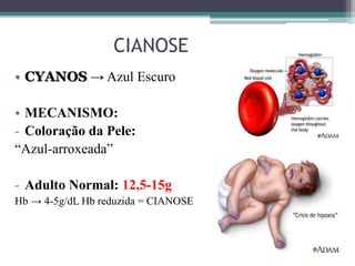 CIANOSE
• CYANOS → Azul Escuro
• MECANISMO:
- Coloração da Pele:
“Azul-arroxeada”
- Adulto Normal: 12,5-15g
Hb → 4-5g/dL Hb reduzida = CIANOSE
 