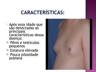 Após essa idade que
são detectadas as
principais
características dessa
doença:
 Pênis e testículos
pequenos
 Estatura elevada
 Pouca pilosidade
pubiana


 