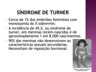




Cerca de 1% dos embriões femininos com
monossomia do X sobrevive;
A incidência de 45,X, ou síndrome de
turner, em meninas recém-nascidas é de
aproximadamente 1 em 8.000 nascimentos.
90% das meninas não desenvolvem as
características sexuais secundárias.
Necessitam de reposição hormonal.

 