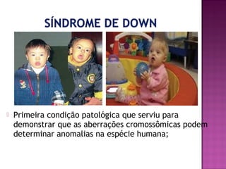 

Primeira condição patológica que serviu para
demonstrar que as aberrações cromossômicas podem
determinar anomalias na espécie humana;

 