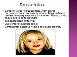 Características
Características físicas parecidas com outros
portadores: dorso do nariz achatado, língua saliente,
orelhas com pequenas dobras salientes, dedos curtos,
com o quinto dedo curvado;
 Boa capacidade imitativa;
 Quociente intelectual baixo;
 Demonstram bastante ritmo e são muito alegres.


 