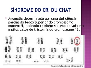 

Anomalia determinada por uma deficiência
parcial do braço superior do cromossomo
número 5, podendo também ser encontrada em
muitos casos de trissomia do cromossomo 18;

 
