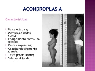Características:








Baixa estatura;
Membros e dedos
curtos;
Comprimento normal do
tronco;
Pernas arqueadas;
Cabeça relativamente
grande;
Testa proeminente;
Sela nasal funda.

 