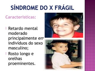 Características:




Retardo mental
moderado
principalmente em
indivíduos do sexo
masculino;
Rosto longo e
orelhas
proeminentes.

 