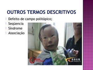 




Defeito de campo politópico;
Seqüencia
Síndrome
Associação

 