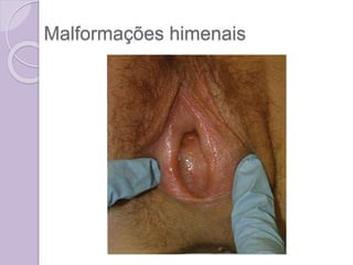 Malformações himenais
 