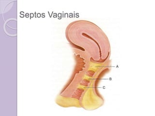 Septos Vaginais
 
