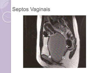 Septos Vaginais
 