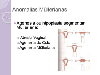 Anomalias Müllerianas
Agenesia ou hipoplasia segmentar
Mülleriana:
o Atresia Vaginal
oAgenesia do Colo
oAgenesia Mülleriana
 