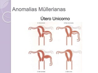 Anomalias Müllerianas
Útero Unicorno
 