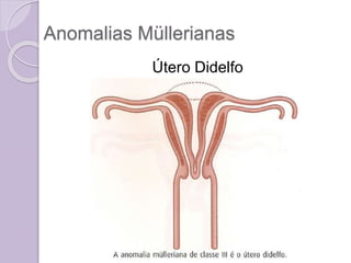 Anomalias Müllerianas
Útero Didelfo
 