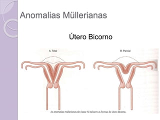 Anomalias Müllerianas
Útero Bicorno
 