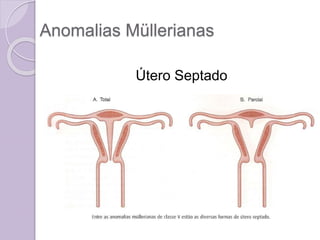 Anomalias Müllerianas
Útero Septado
 