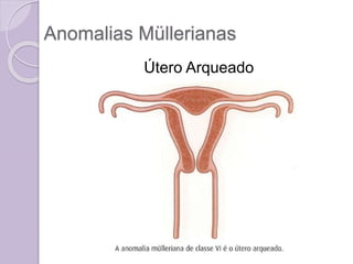 Anomalias Müllerianas
Útero Arqueado
 