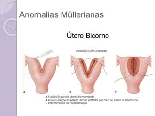 Anomalias Müllerianas
Útero Bicorno
 