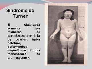 Síndrome de Turner 
É observada somente em mulheres, se caracteriza por falta de ovários, baixa estatura, deformações esqueléticas .É uma monossomia no cromossomo X. 
 
