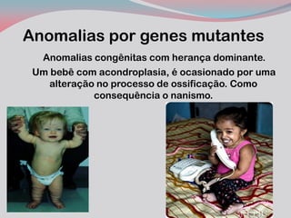 Anomalias por genes mutantes 
Anomalias congênitas com herança dominante. 
Um bebê com acondroplasia, é ocasionado por uma alteração no processo de ossificação. Como consequência o nanismo.  