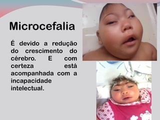 Microcefalia 
É devido a redução do crescimento do cérebro. E com certeza está acompanhada com a incapacidade intelectual.  